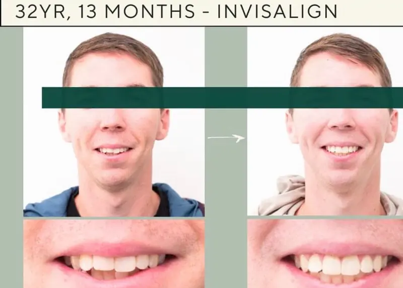Before and after Invisalign