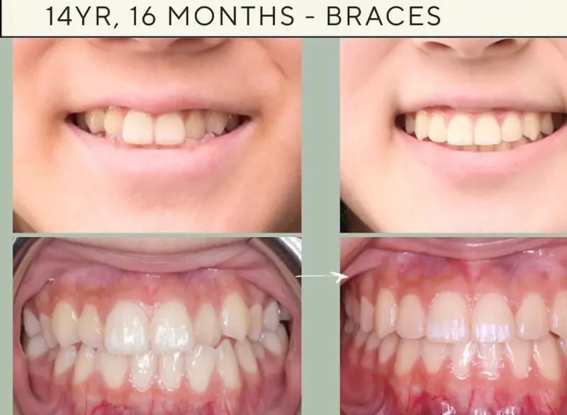 Before and after braces